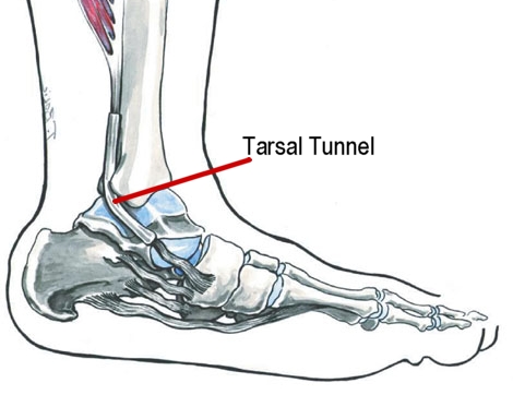 Tarsal Tunnel Syndrome | New Health Guide