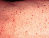 disease grover chest skin image001 newhealthguide