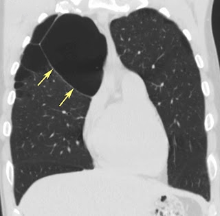 Bullae of Lung | New Health Guide