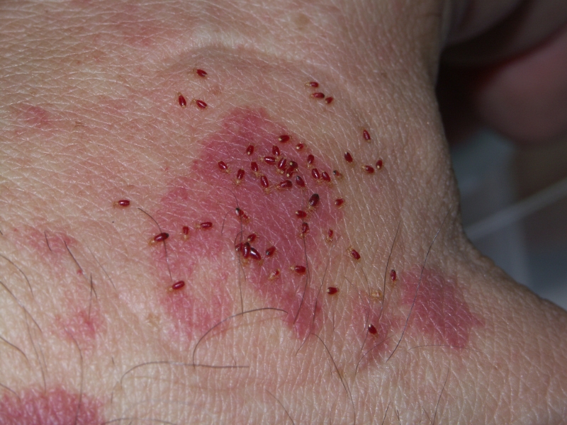 Bed Bug Bites Pictures, Symptoms and Treatment