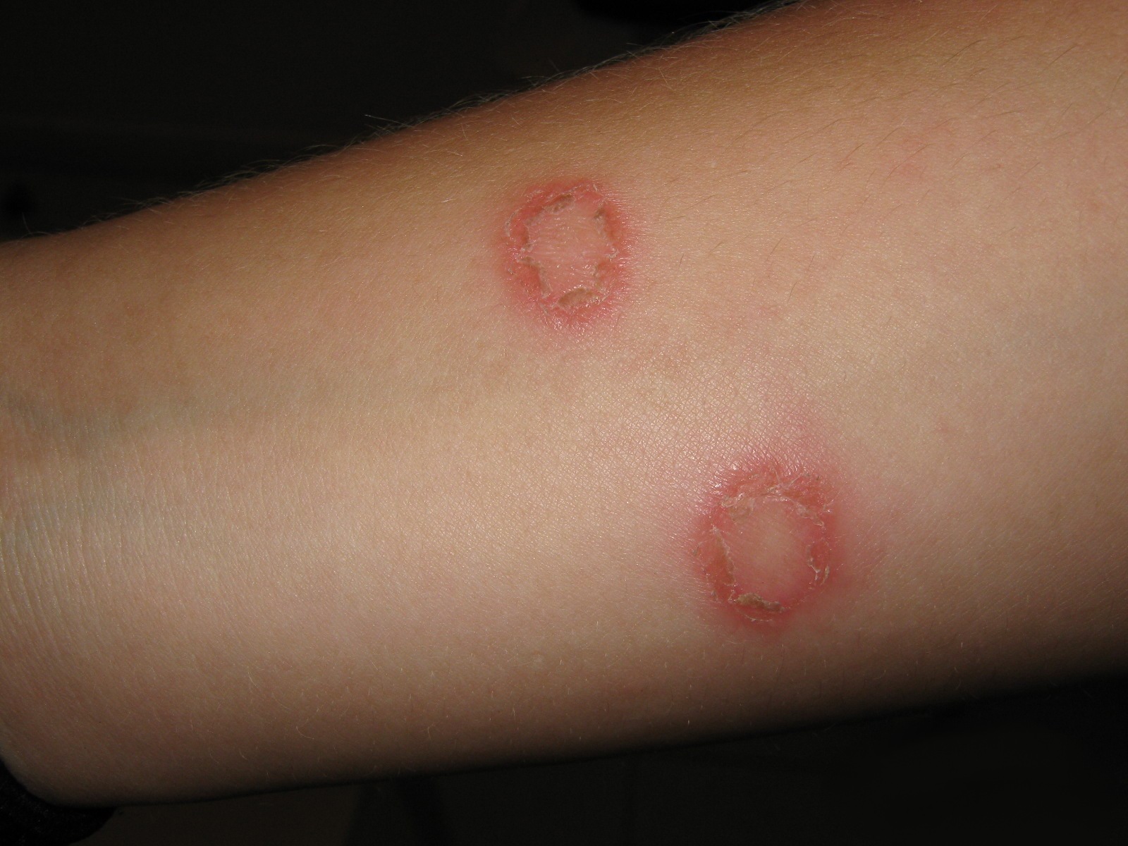 skin infection picture #10