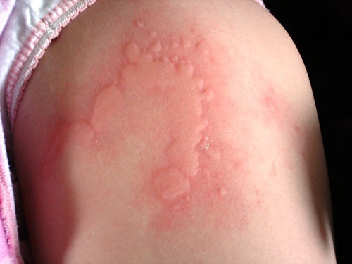 Hives: Causes, Risks, Prevention & Pictures - Healthline