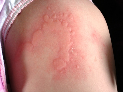 raised itchy rash #9