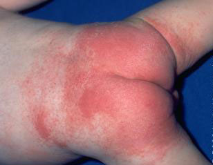 Skin conditions: Common rashes - WebMD Boots