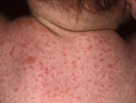 Itchy Rash in Children | New Health Guide