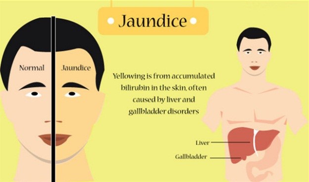 What Causes Jaundice? | New Health Guide