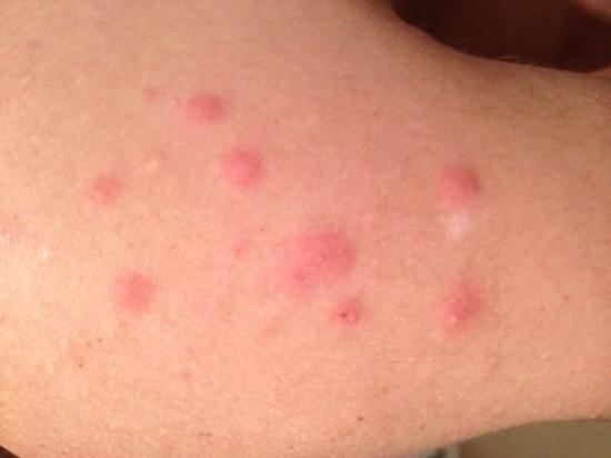 Bites and Infestations: Pictures of Bug Bites, Stings ...