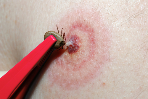 What is the treatment for tick bites?