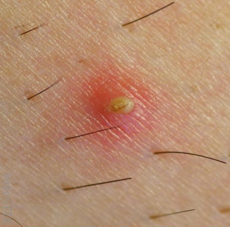Ingrown Hair Or Wart - Doctor answers on HealthTap