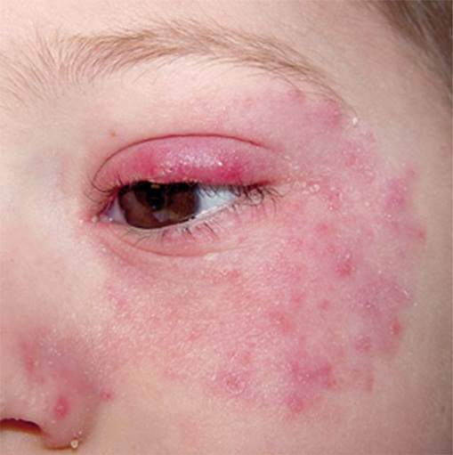 Under EYE rash irritation | Skin Itching & Rashes ...