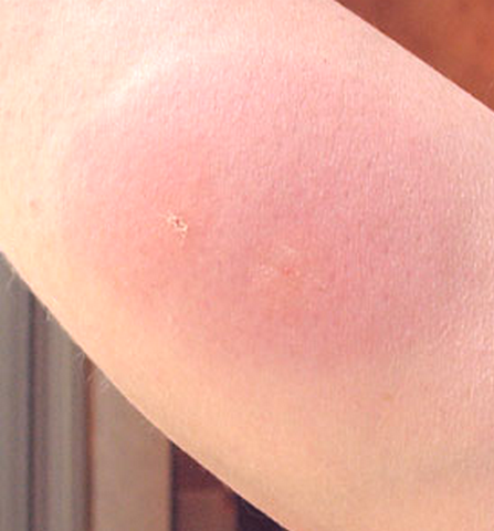 Bed Bug Bites Pictures, Symptoms and Treatment