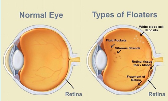 What Are the Symptoms of Eye Floaters?