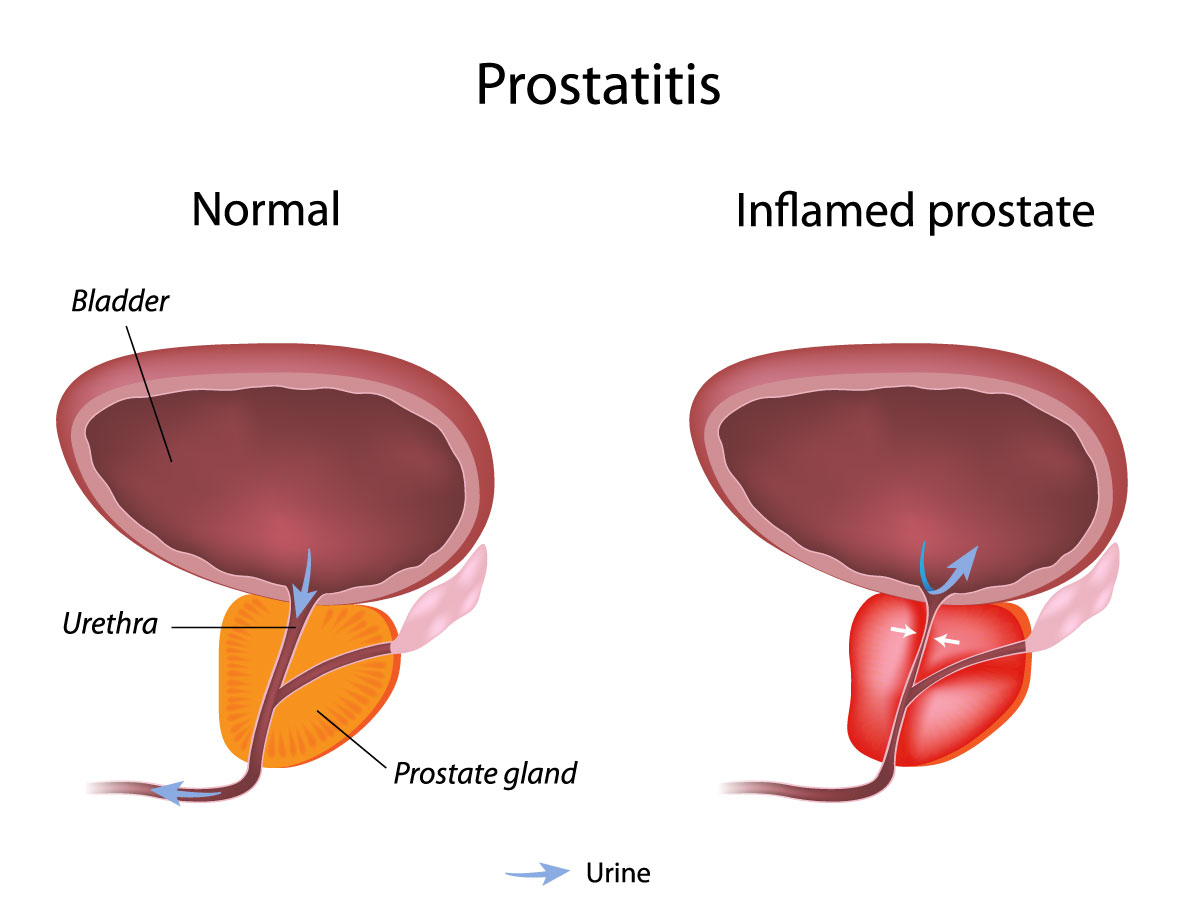 Acute Bacterial Prostatitis Symptoms Treatment Exercises Best Creatine Supplements To Get 