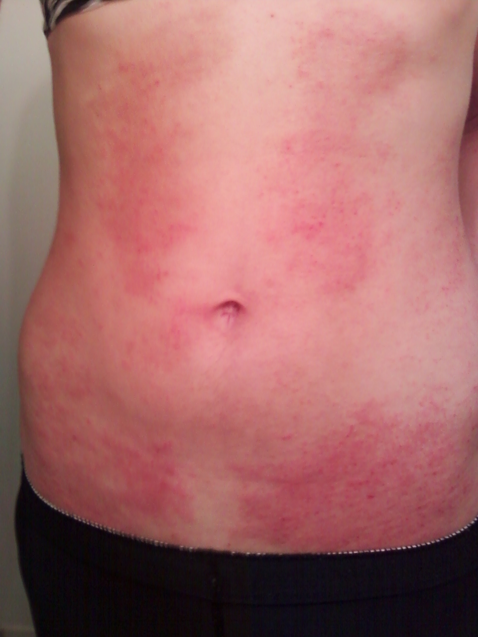 rash on torso and back #10