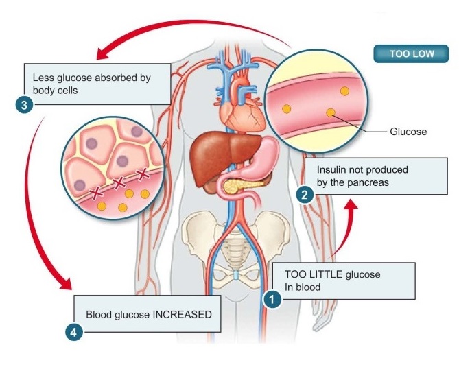 What is considered a high glucose level?