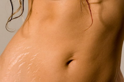 How to Hide Your Stretch Marks Effectively | New Health Guide