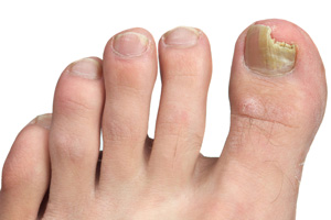 Nail Lifting (Onycholysis) in Adults: Condition ...