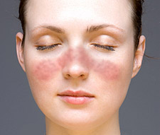 Sun allergy home remedies