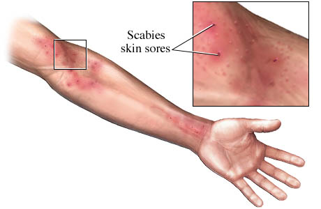 how to get rid of scabies | new health guide