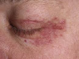 What causes rashes to form around one eye but not the ...