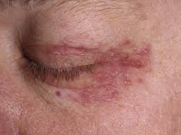 skin rashes around eye #10