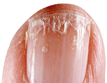 what causes cracks in the skin around the fingernails