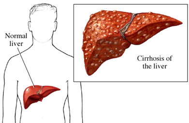 What are the symptoms associated with end-stage liver disease?