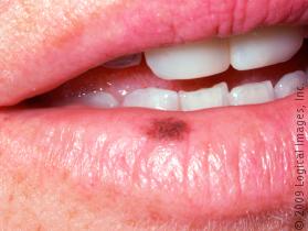 Causes and treatment of black spots on lips