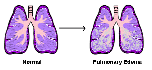 What causes fluid in the lungs?