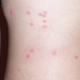 Flea Bites vs. Bed Bug Bites | New Health Guide