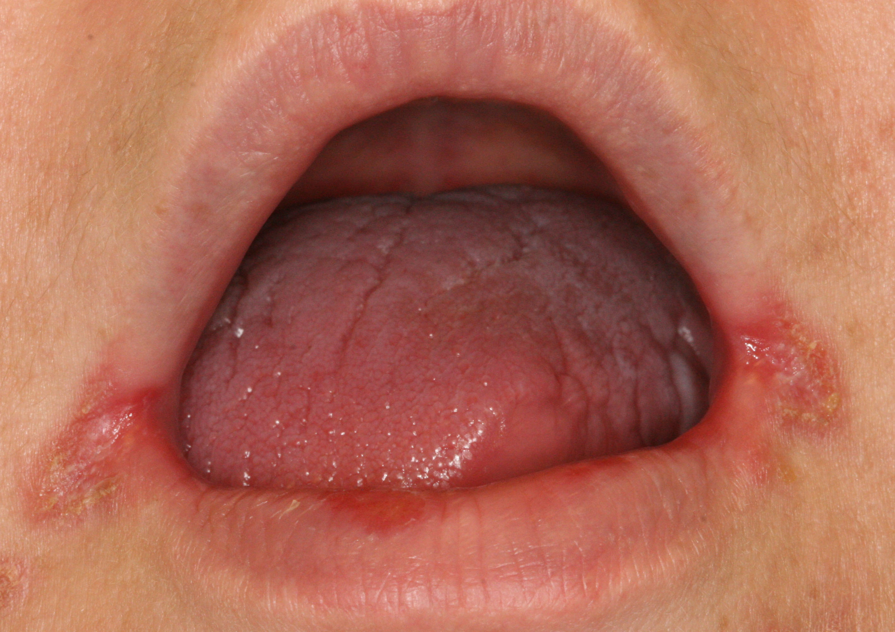 Corner Of Mouth Irritation 105