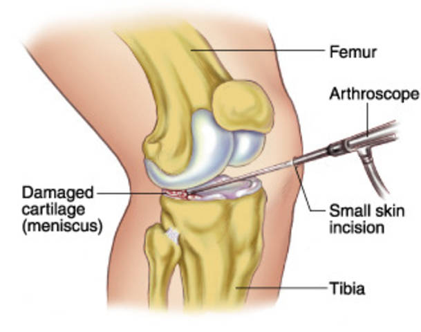 What is the quickest possible recovery time after knee surgery for a torn meniscus?