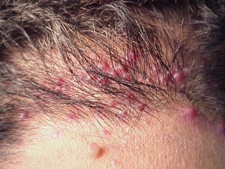 Infected ingrown hair boil Infected ingrown hair boil