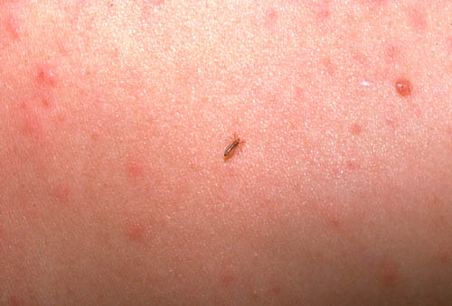 body lice rash