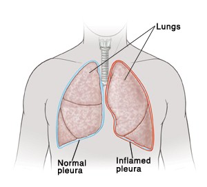 pleurisy right pain rib cage under lung pleura chest lungs causes pleural normal front inflammation left line where painful between