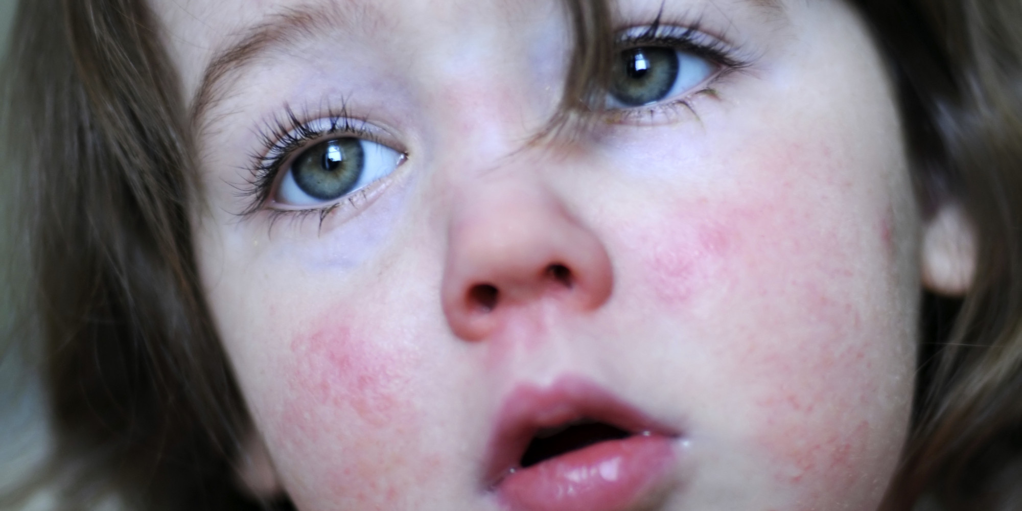 Itchy Rash in Children | New Health Guide