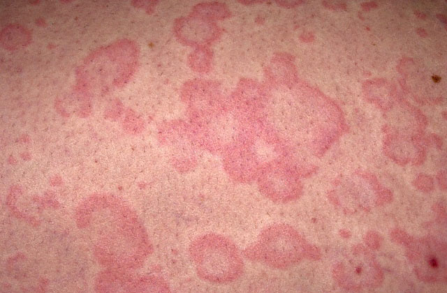 Allergic Reaction Rash New Health Guide