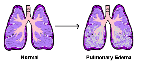 lungs fluid edema pulmonary lung symptoms gif normal filled ncp anxiety buildup air complications sacs newhealthguide